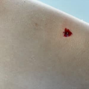 SIMSLEEVE - Schussverletzung Oberarm – Bild 3